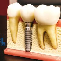 All on 6 Dental Implants in New York | MCL Dental Labs